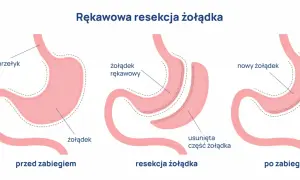 Ilustracja pokazuje proces rękawowej resekcji żołądka, procedury bariatrycznej, która zmniejsza jego rozmiar.
