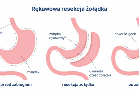 Ilustracja pokazuje proces rękawowej resekcji żołądka, procedury bariatrycznej, która zmniejsza jego rozmiar.