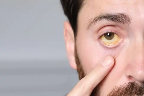 Podwyższona bilirubina: Jakie leki i kiedy? Diagnoza to podstawa
