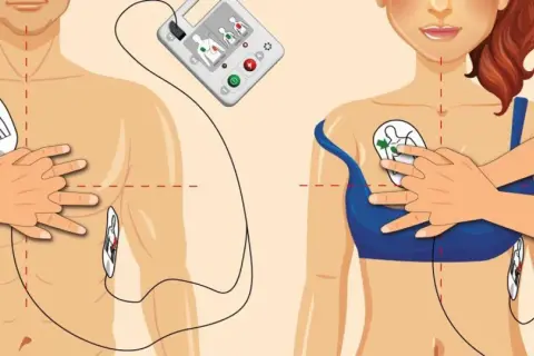Instrukcja użycia AED: przyklej elektrody na klatce piersiowej, aby rozpocząć resuscytację.