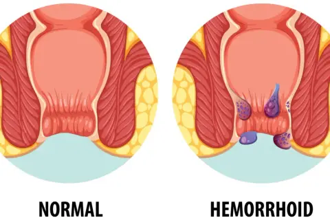 Hemoroidy: Do jakiego lekarza iść? Pełny przewodnik po leczeniu