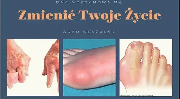 Dna moczanowa: Jaki lekarz pomoże? Skuteczna ścieżka leczenia