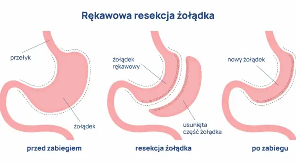 Ilustracja pokazuje proces rękawowej resekcji żołądka, procedury bariatrycznej, która zmniejsza jego rozmiar.