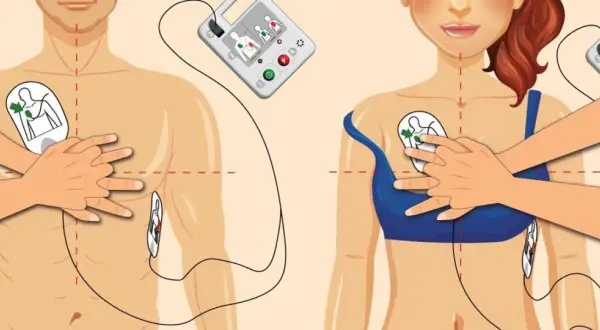 Instrukcja użycia AED: przyklej elektrody na klatce piersiowej, aby rozpocząć resuscytację.