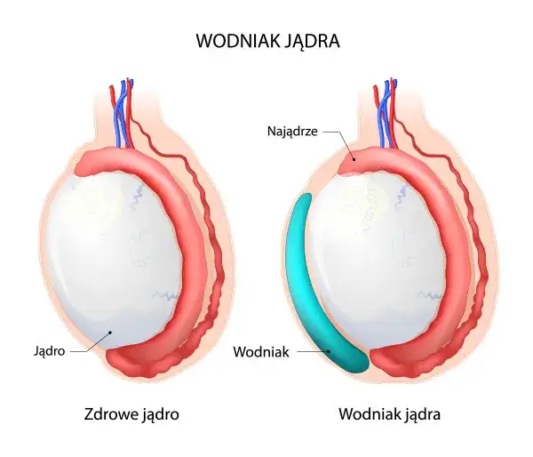 nowotwór jądra żylaki powrózka nasiennego wodniak jądra