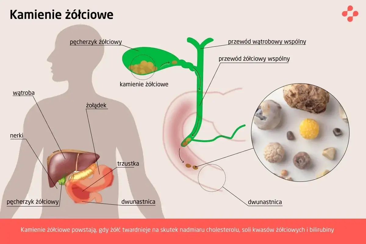 schemat ścieżki pacjenta woreczek żółciowy NFZ