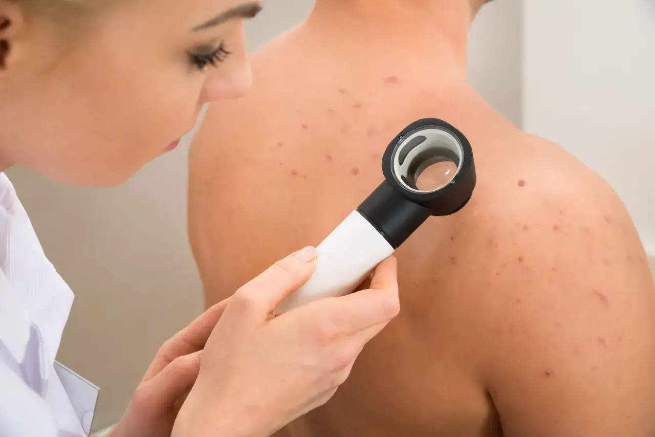 Dermatolog bada plecy pacjenta z trądzikiem. Czy do dermatologa potrzebne jest skierowanie? Zależy od placówki.