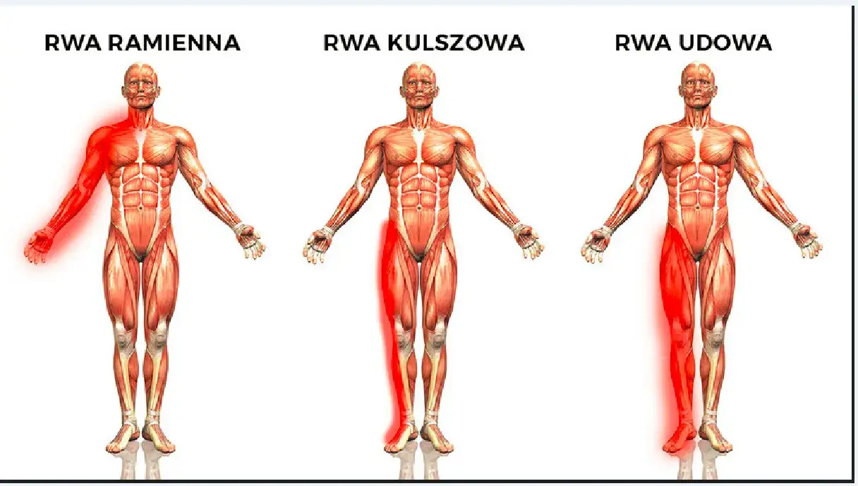 objawy alarmowe rwa kulszowa SOR
