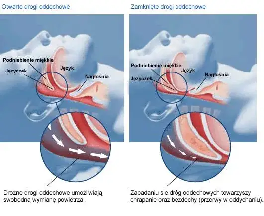 schemat ścieżki leczenia zaburzeń snu w Polsce