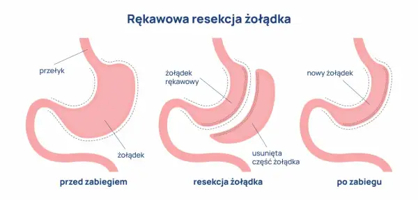 Ilustracja pokazuje proces rękawowej resekcji żołądka, procedury bariatrycznej, która zmniejsza jego rozmiar.